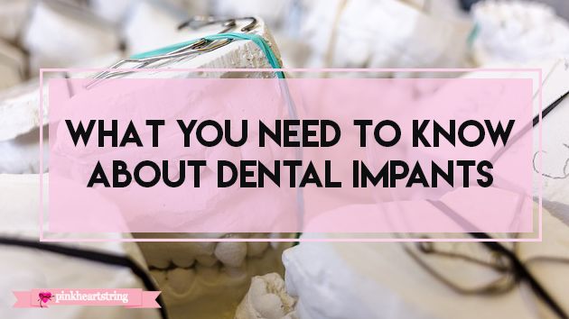 dental implants