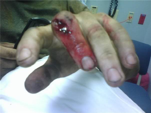 injury serious scratches finger moderate papercuts kicked 1994 surgery